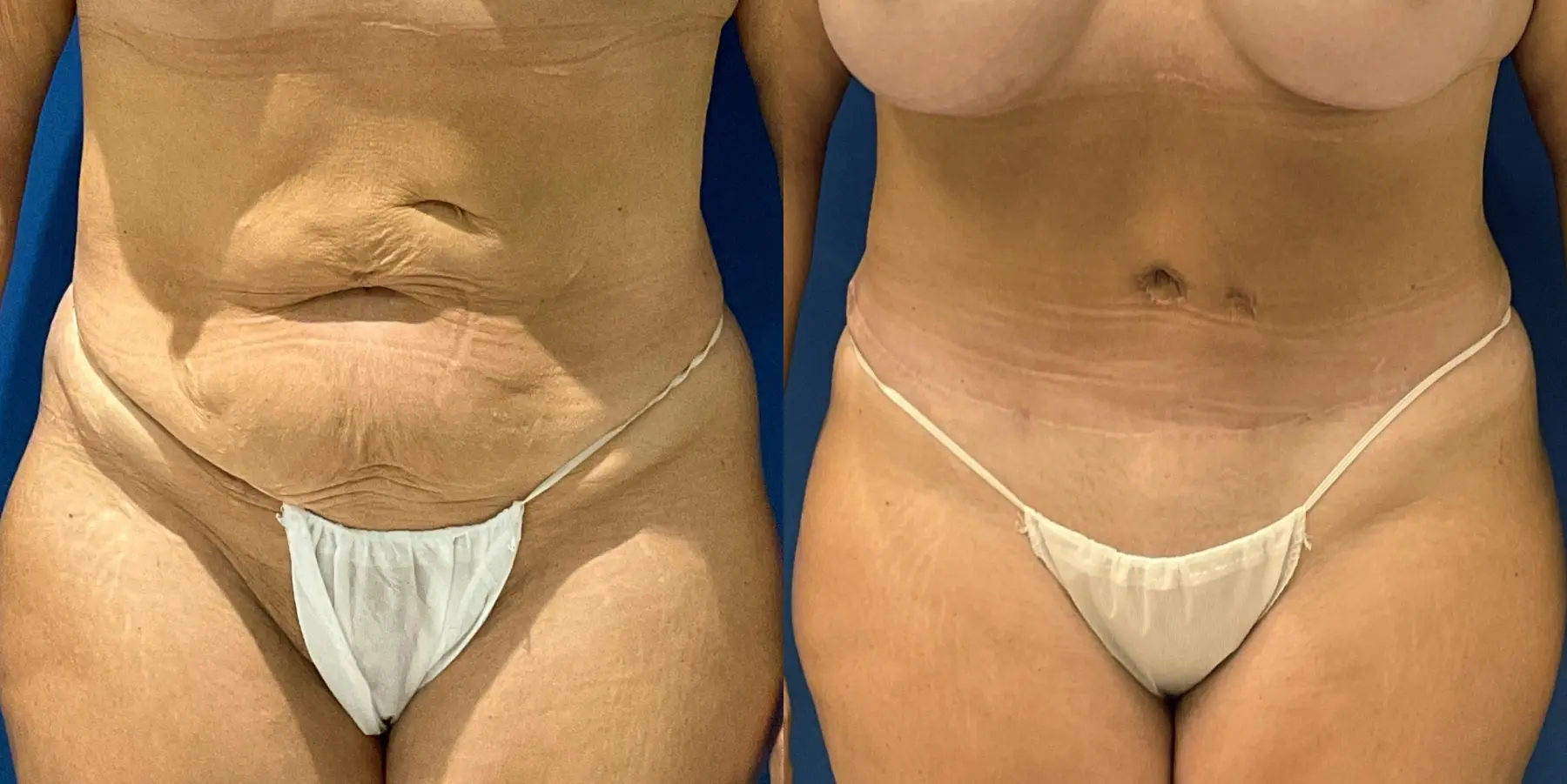 Tummy Tuck: Patient 8 - Before and After  