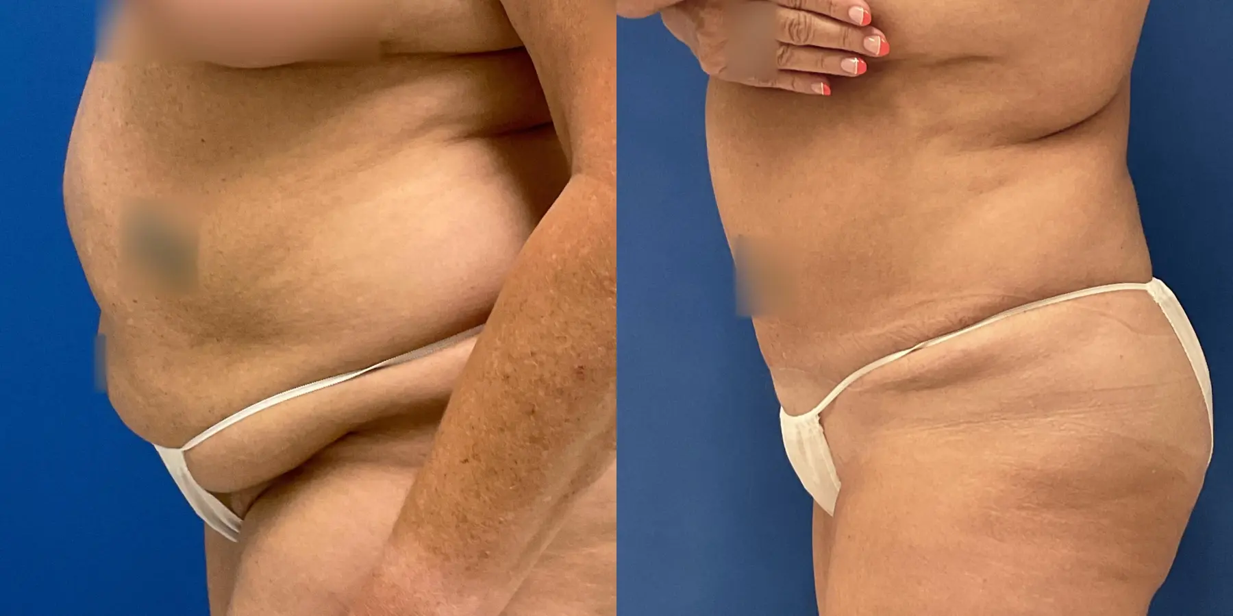 Tummy Tuck: Patient 32 - Before and After 3