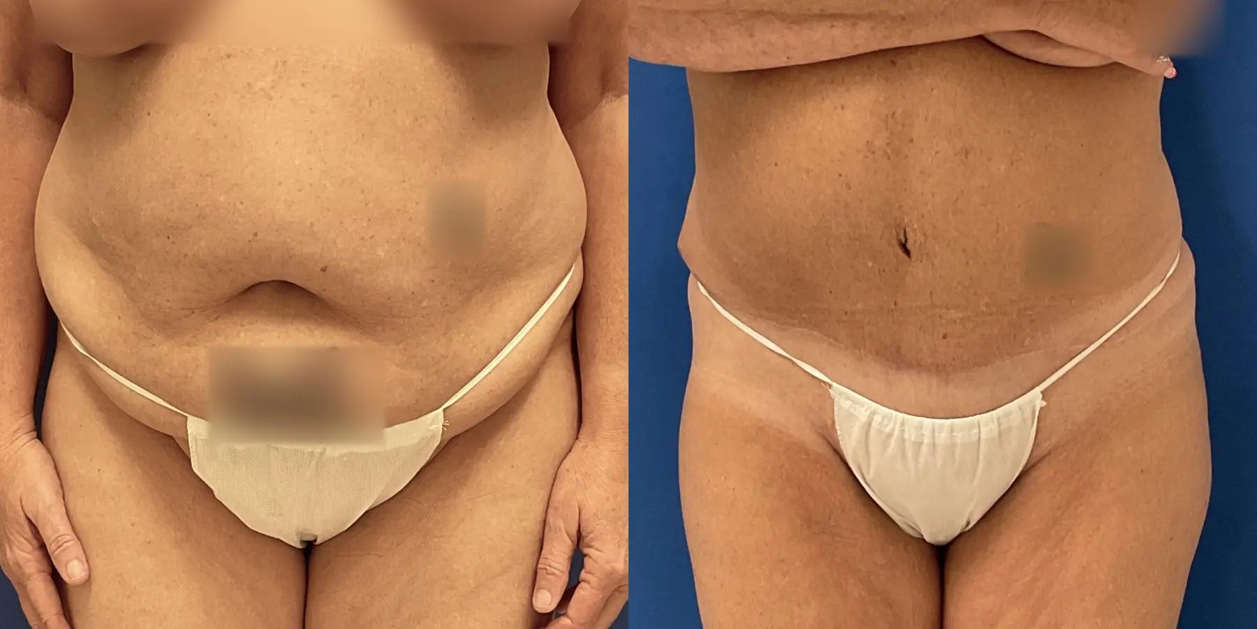 Tummy Tuck: Patient 32 - Before and After 1