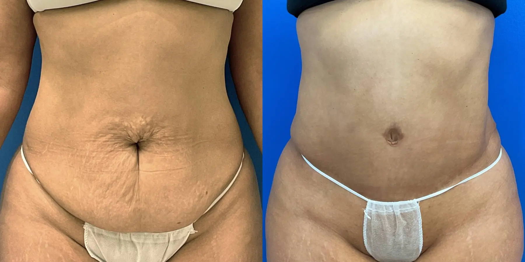 Tummy Tuck: Patient 31 - Before and After 1
