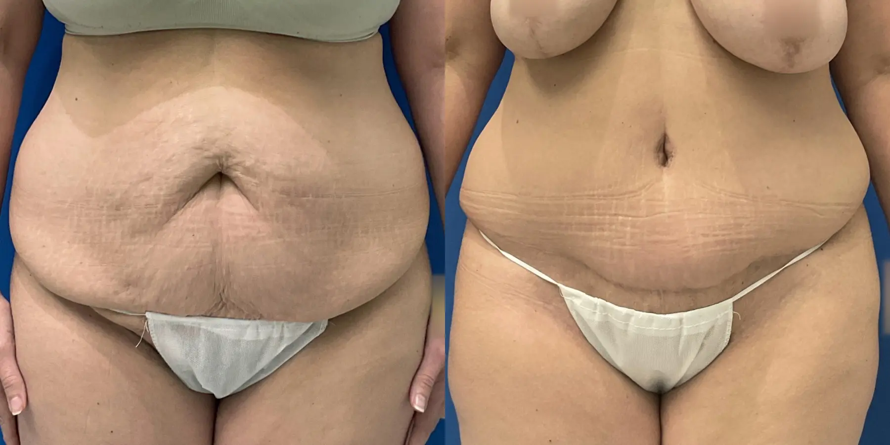 Tummy Tuck: Patient 6 - Before and After  