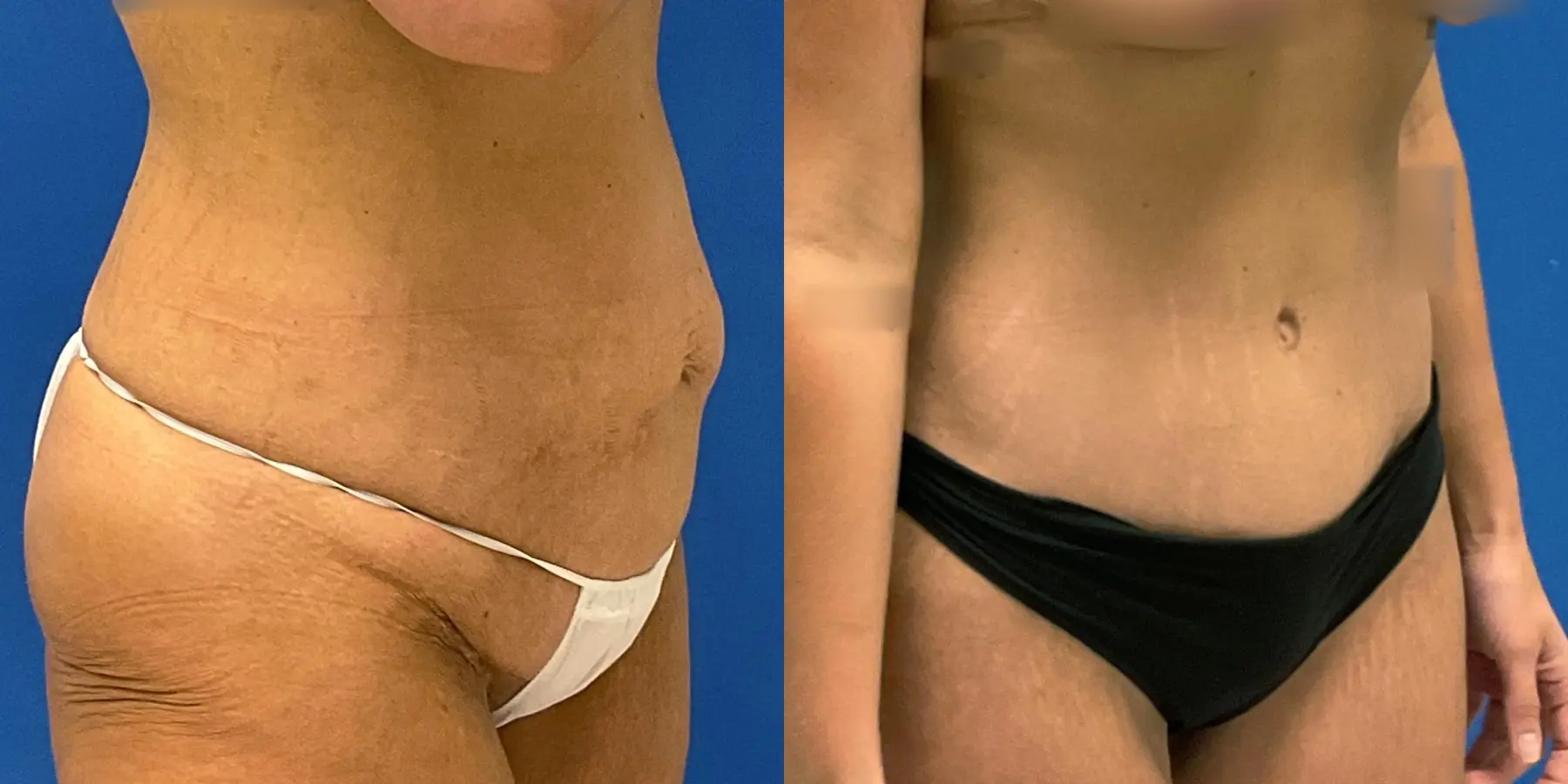 Tummy Tuck: Patient 34 - Before and After 3