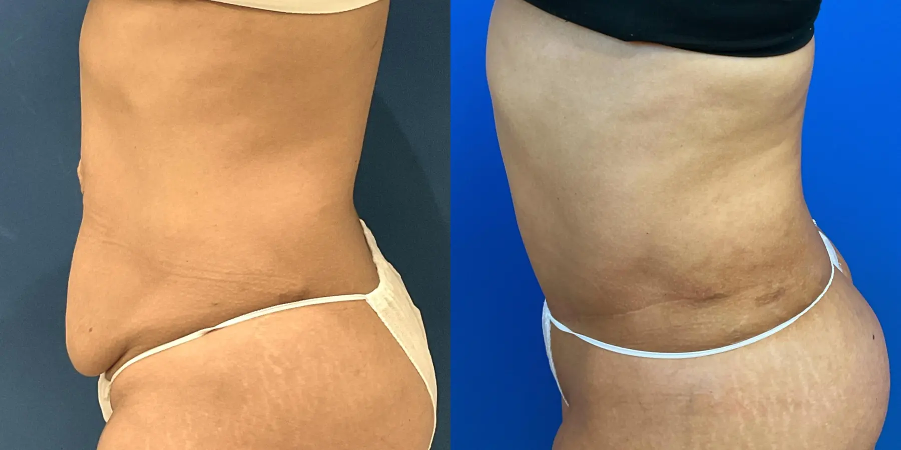 Tummy Tuck: Patient 31 - Before and After 4