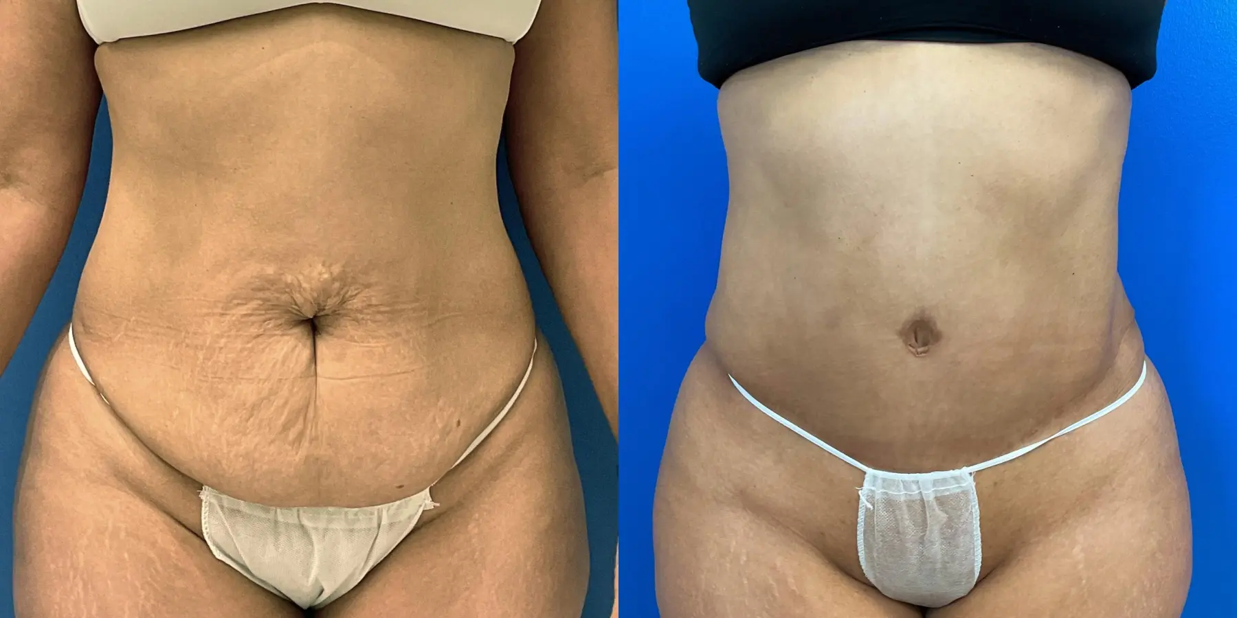 Tummy Tuck: Patient 3 - Before and After  