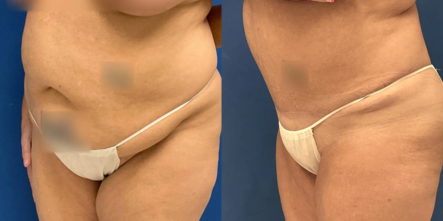 Tummy Tuck: Patient 32 - Before and After 2
