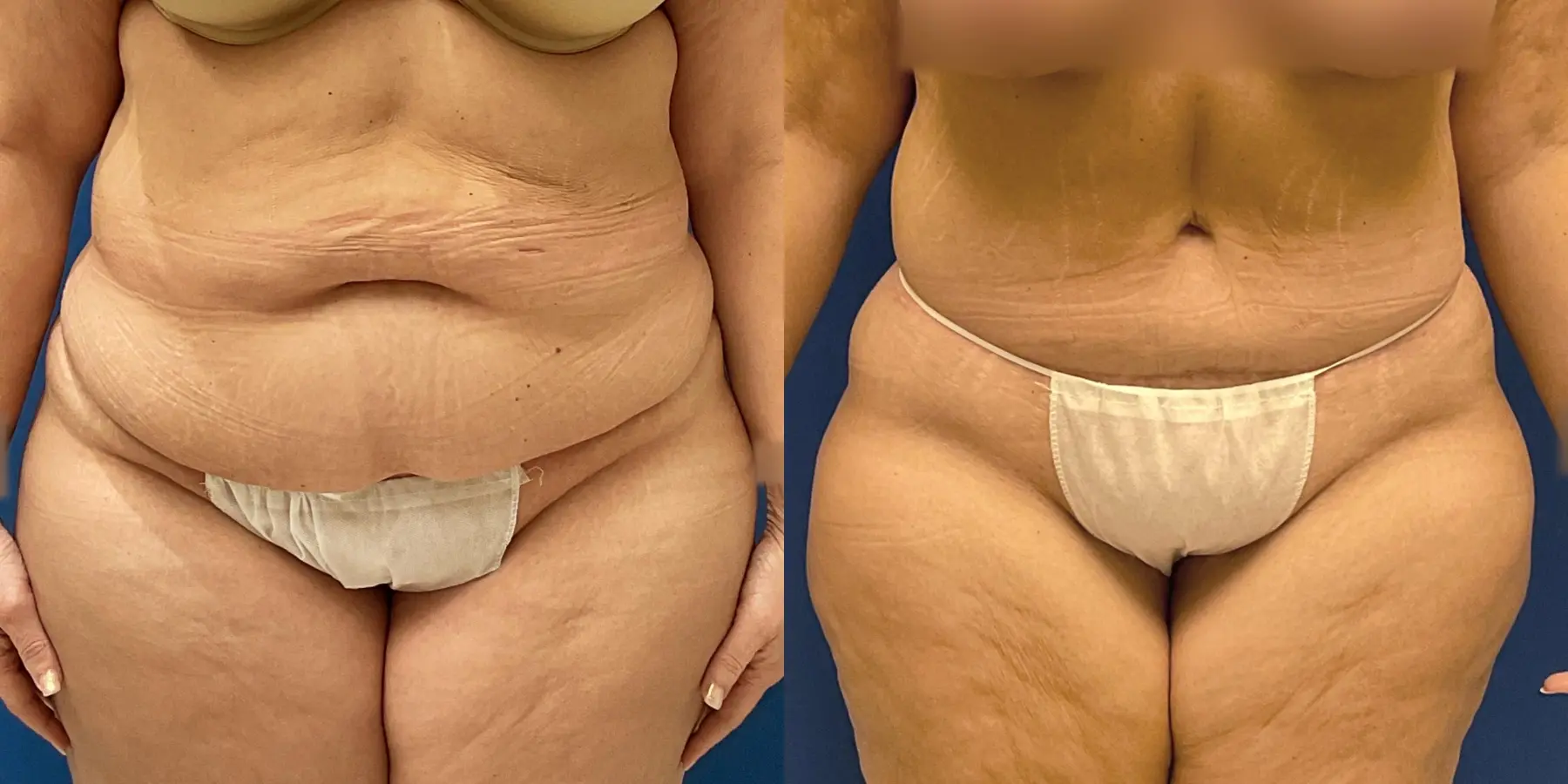 Tummy Tuck: Patient 5 - Before and After  
