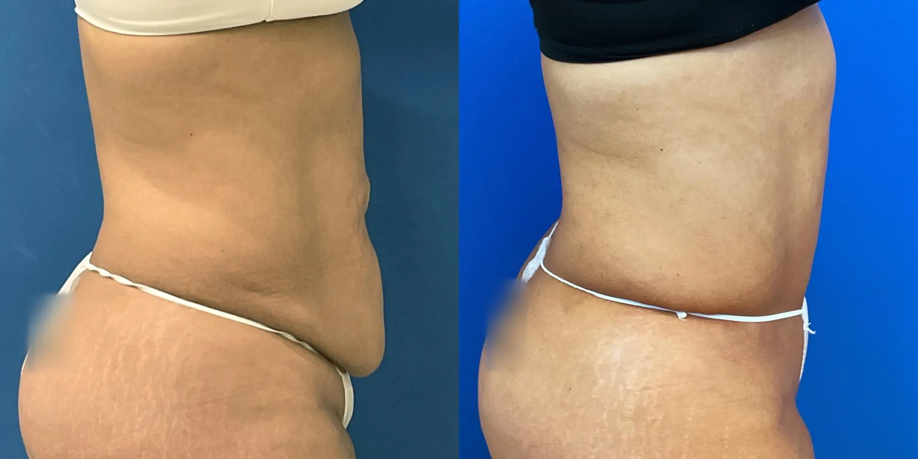 Tummy Tuck: Patient 31 - Before and After 5