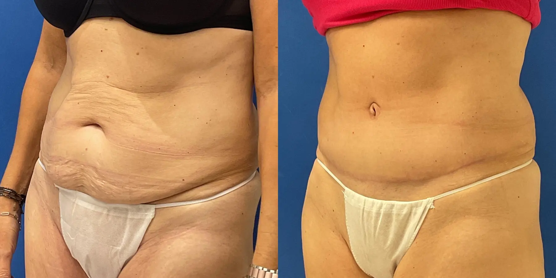 Tummy Tuck: Patient 33 - Before and After 2