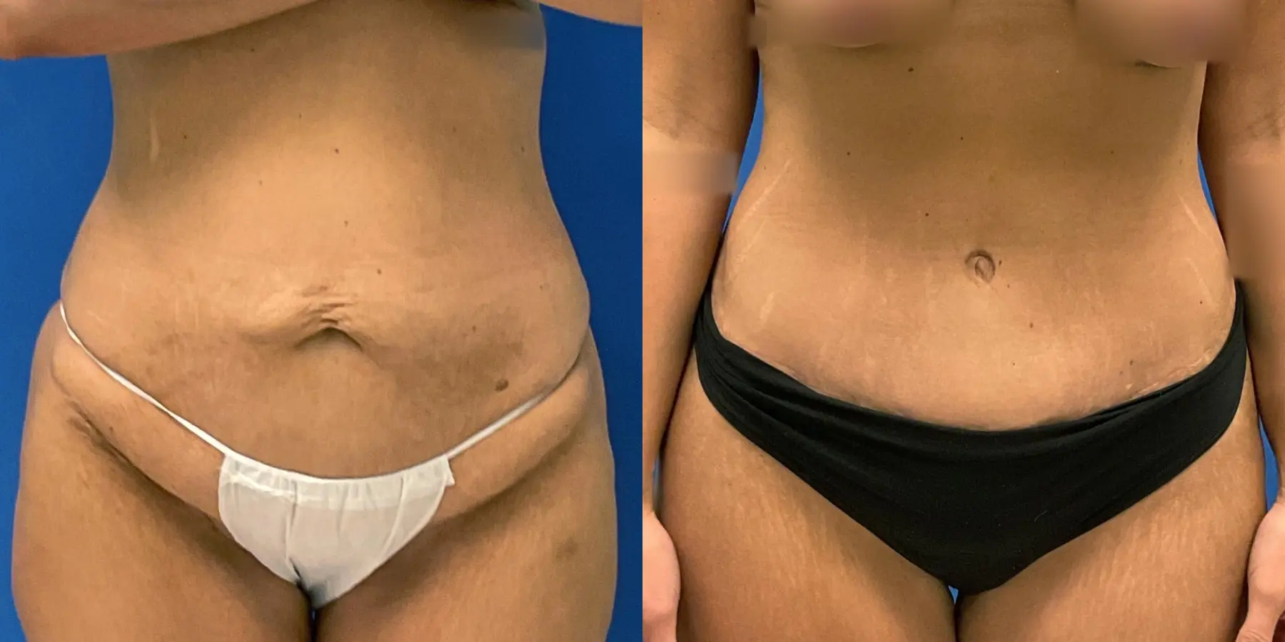 Tummy Tuck: Patient 34 - Before and After 1