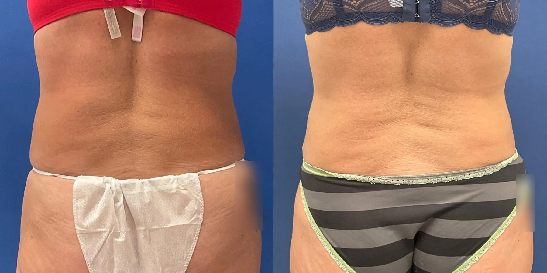 Tummy Tuck: Patient 15 - Before and After 6