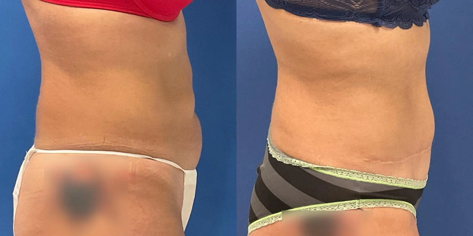 Tummy Tuck: Patient 15 - Before and After 5