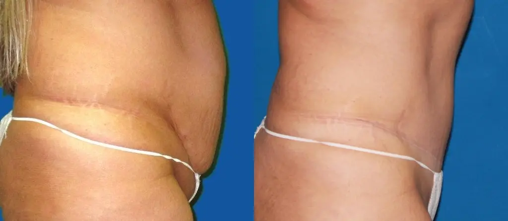 Tummy Tuck: Patient 14 - Before and After 2