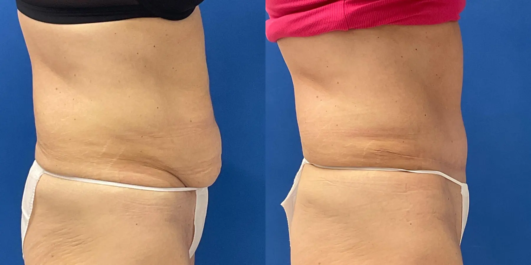 Tummy Tuck: Patient 33 - Before and After 5
