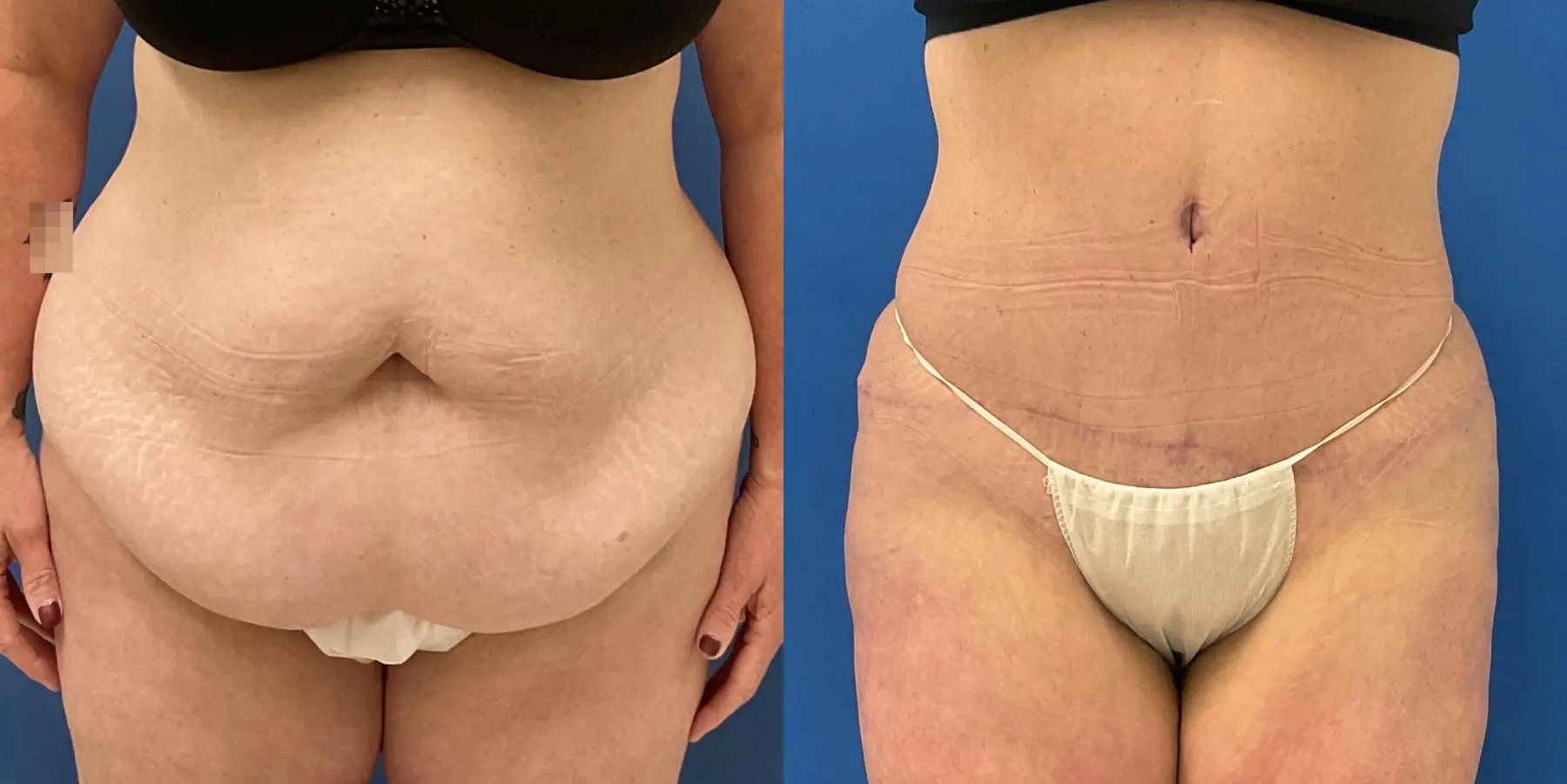 Tummy Tuck: Patient 1 - Before and After  