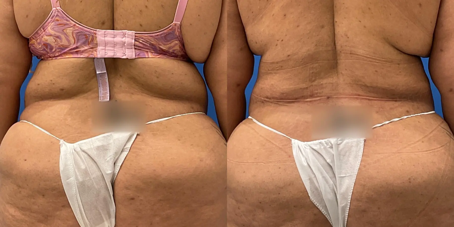 Tummy Tuck: Patient 7 - Before and After 6
