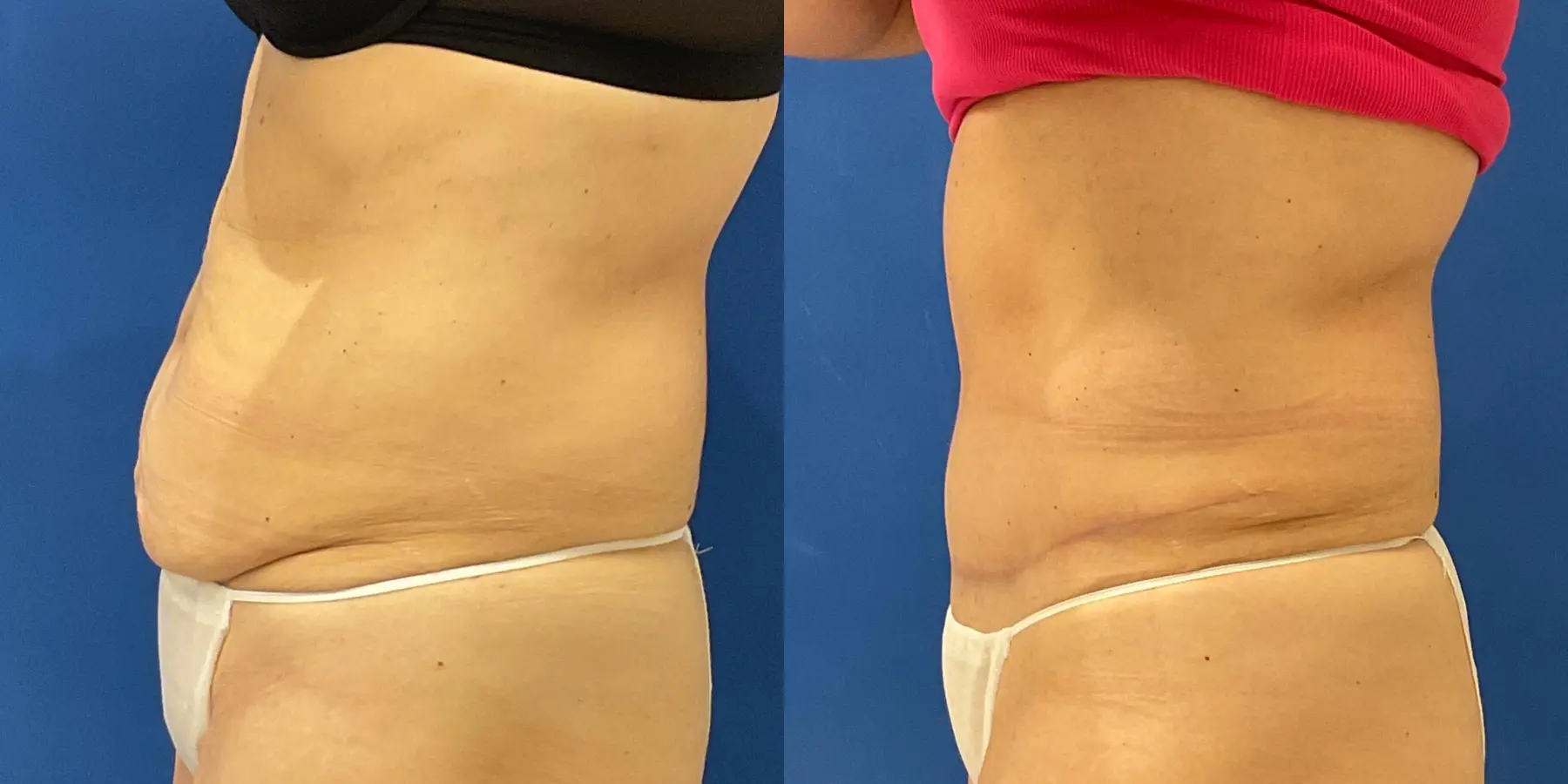 Tummy Tuck: Patient 33 - Before and After 4