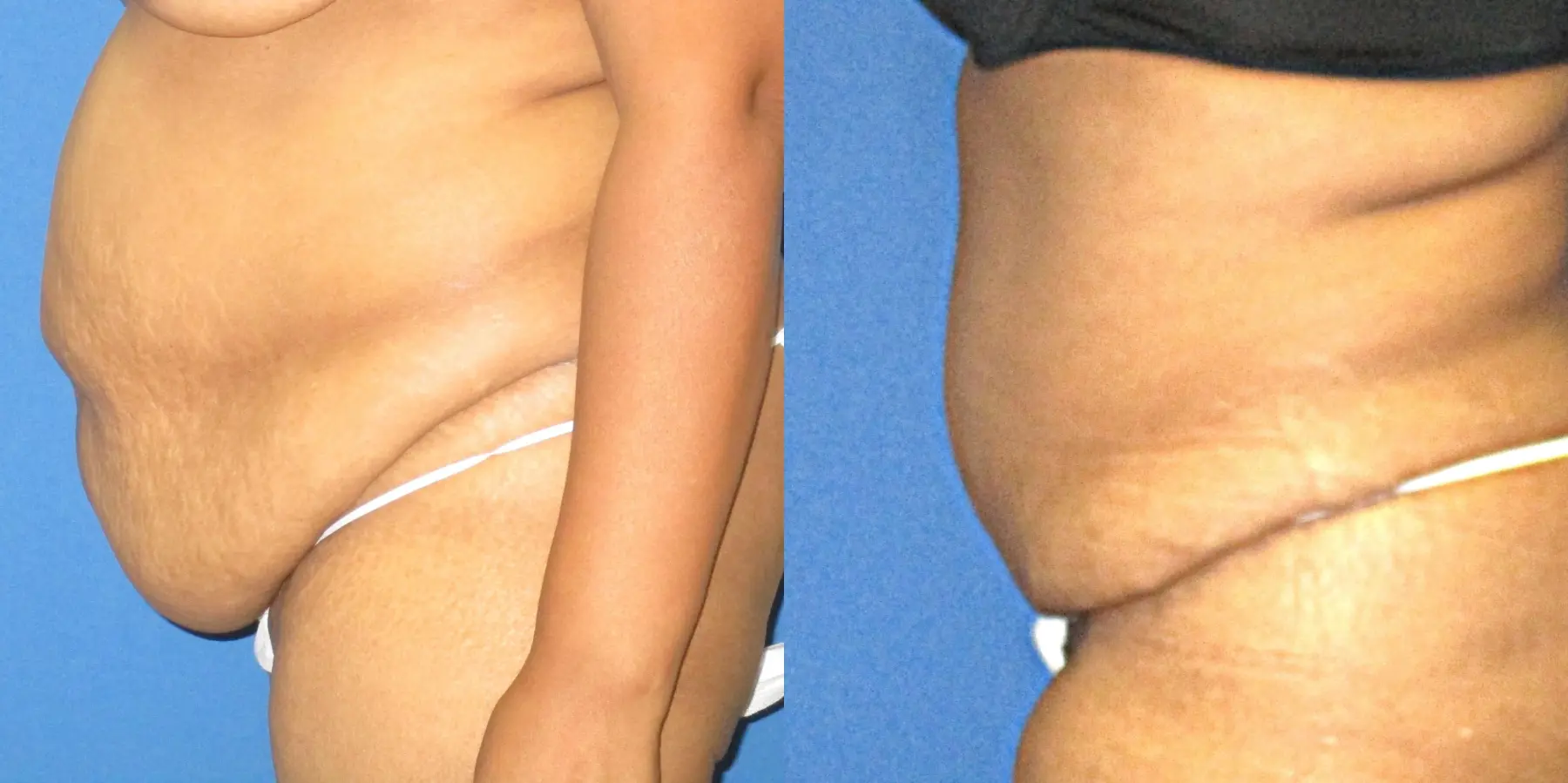 Tummy Tuck: Patient 12 - Before and After 3
