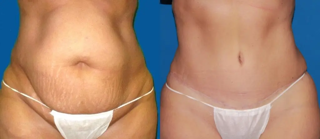 Tummy Tuck: Patient 14 - Before and After 1