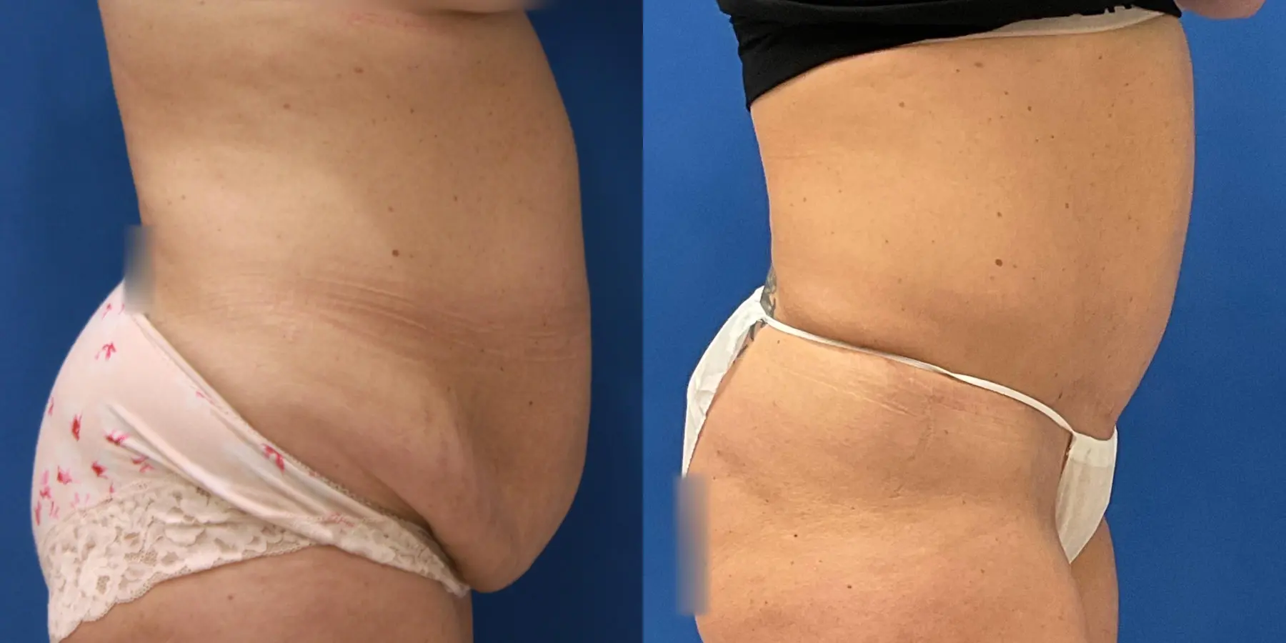Tummy Tuck: Patient 35 - Before and After 3