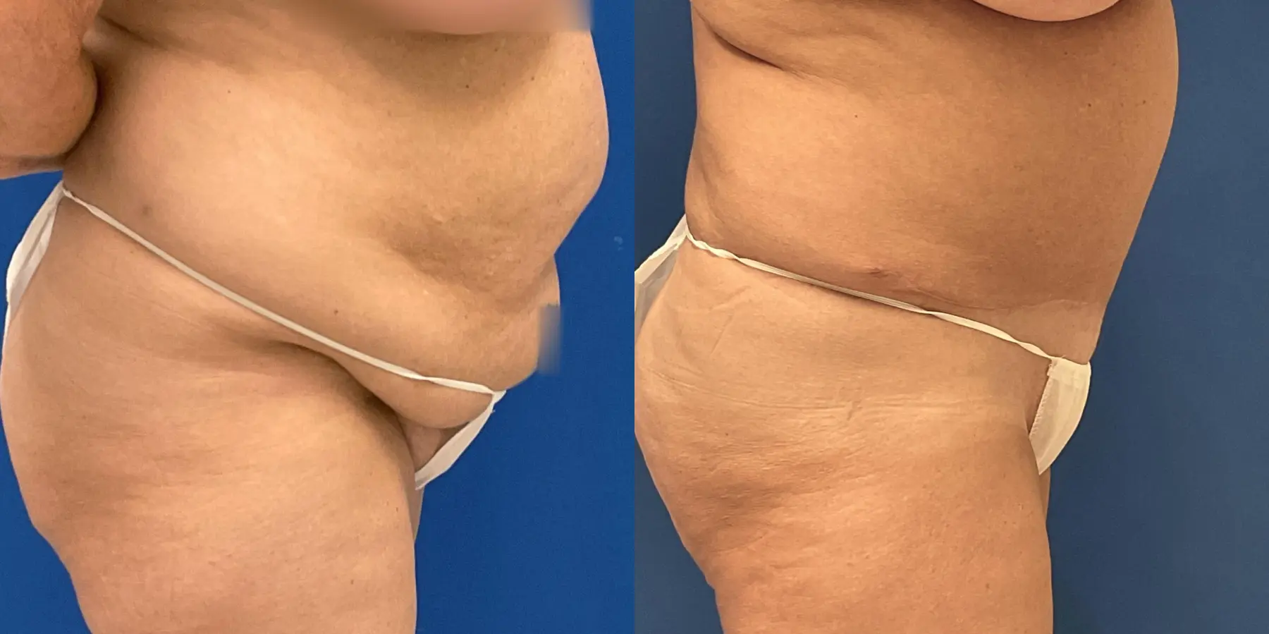 Tummy Tuck: Patient 32 - Before and After 4