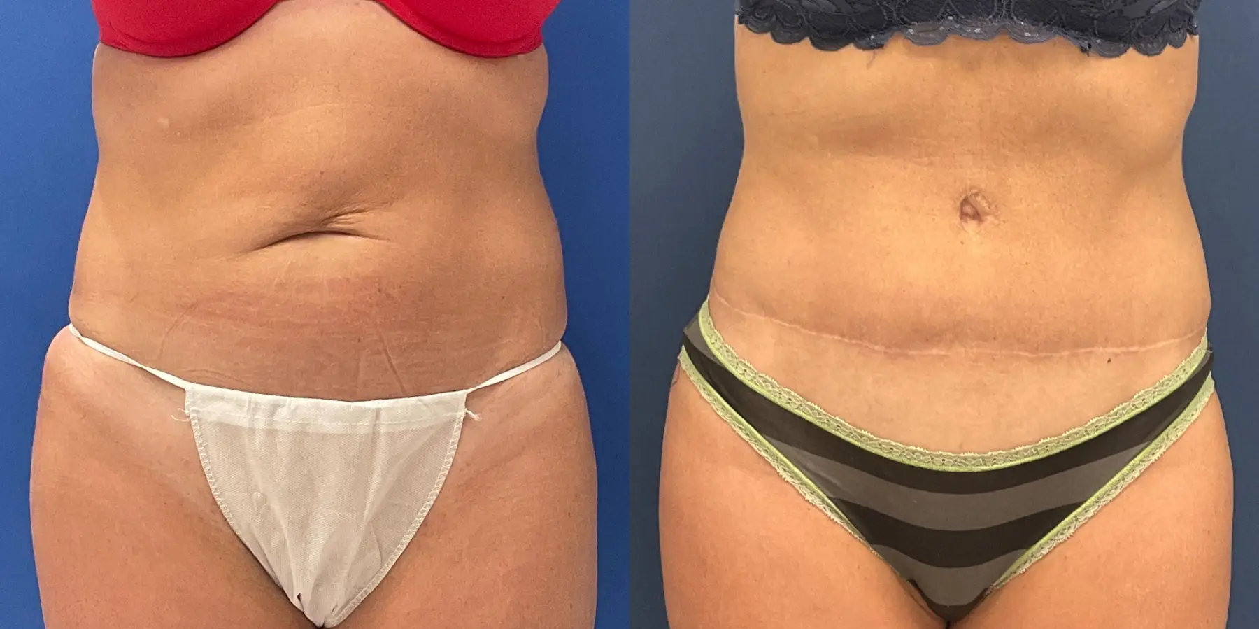 Tummy Tuck: Patient 15 - Before and After 1