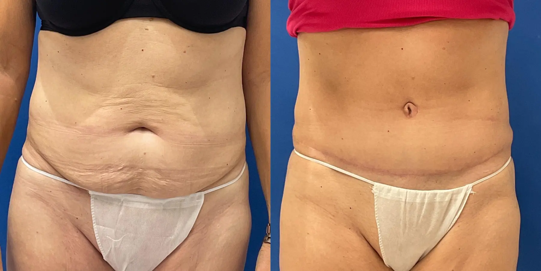 Tummy Tuck: Patient 33 - Before and After 1