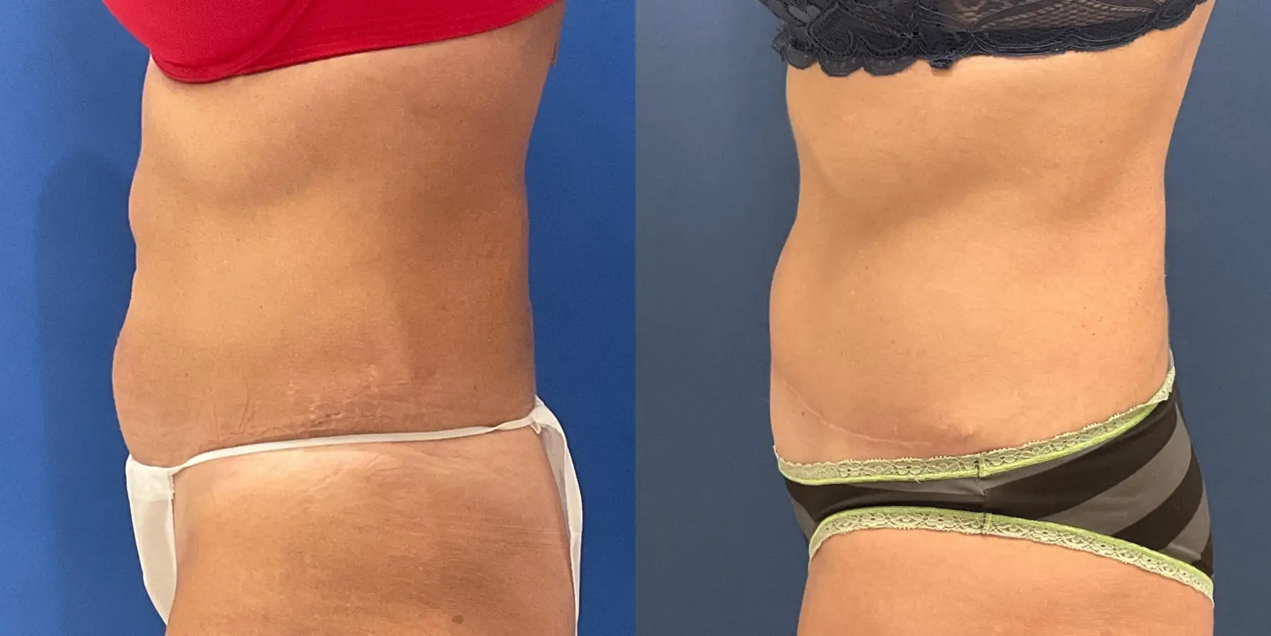 Tummy Tuck: Patient 15 - Before and After 4