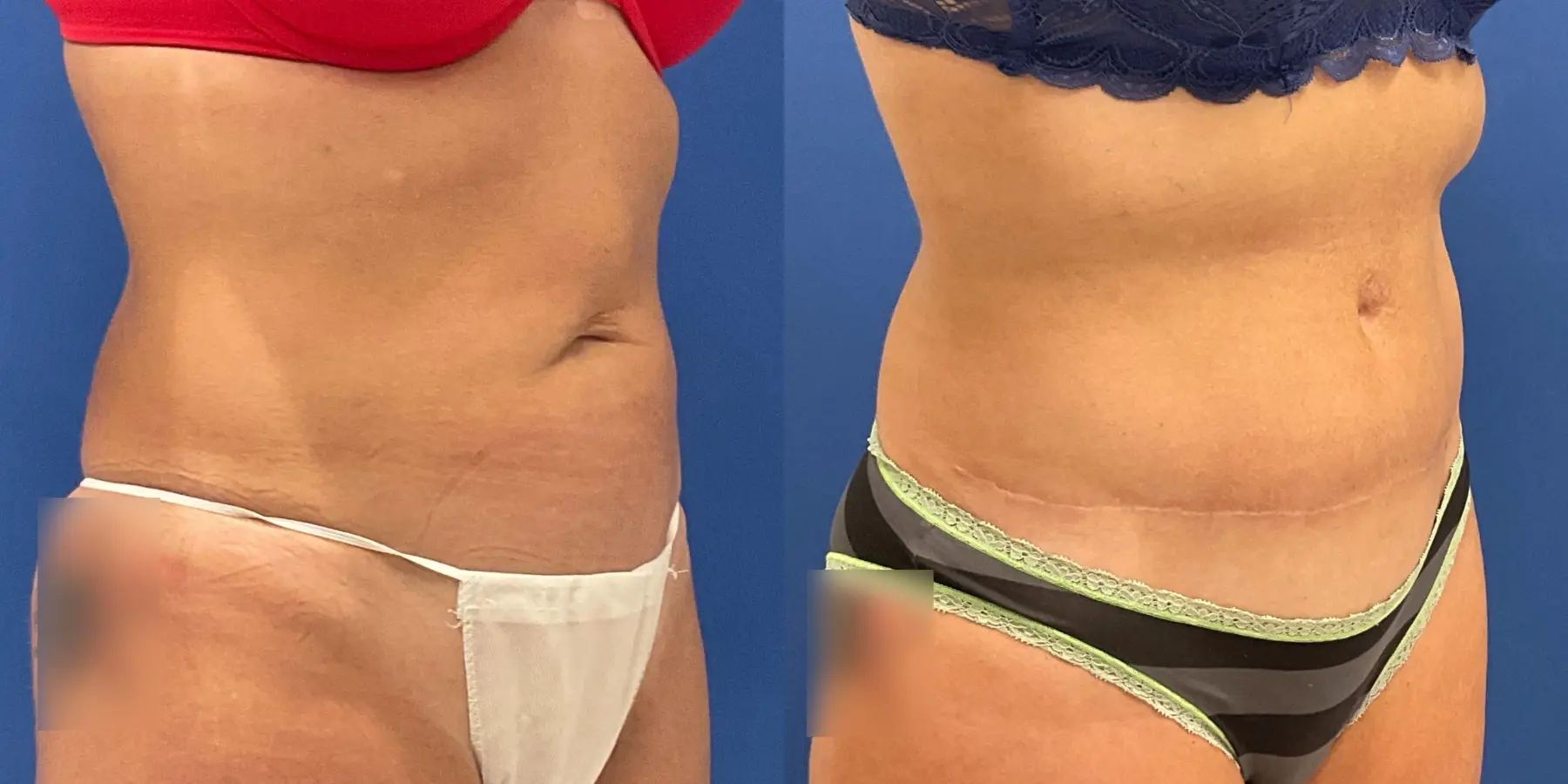 Tummy Tuck: Patient 15 - Before and After 3