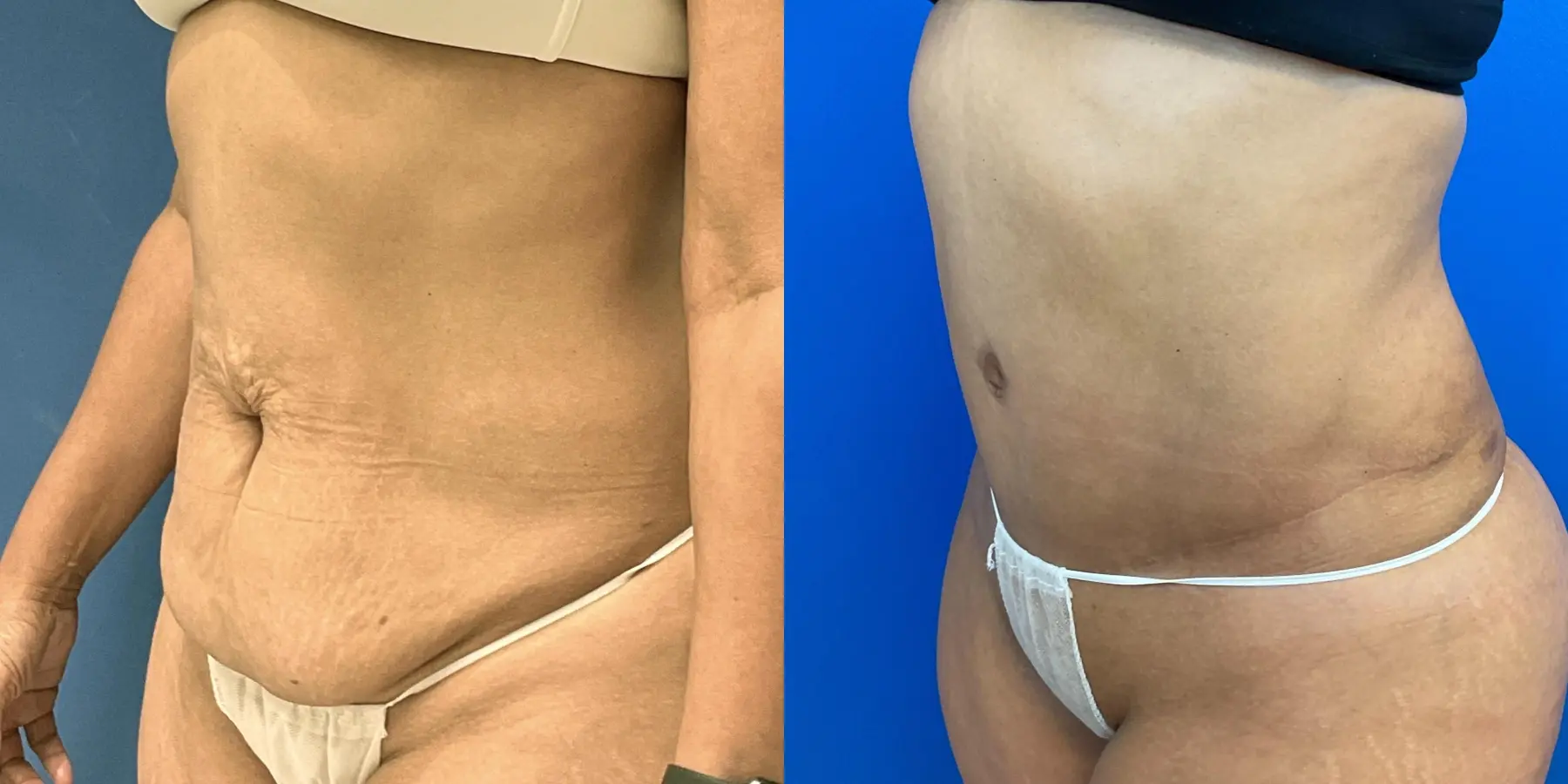 Tummy Tuck: Patient 31 - Before and After 2