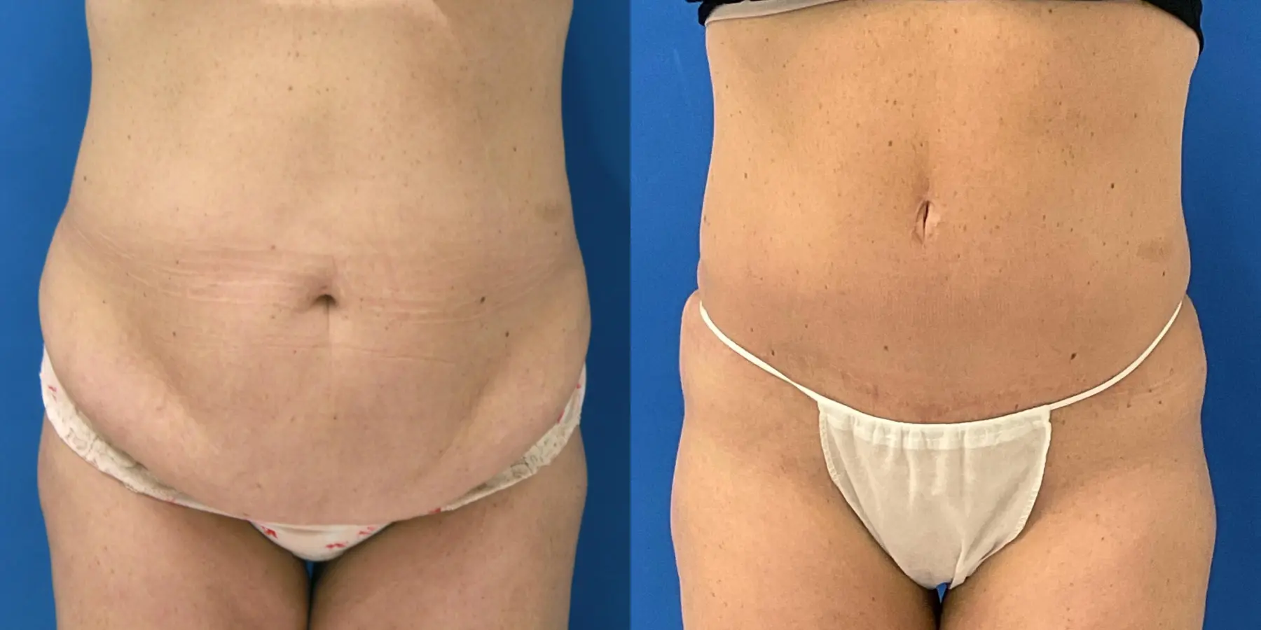 Tummy Tuck: Patient 35 - Before and After  