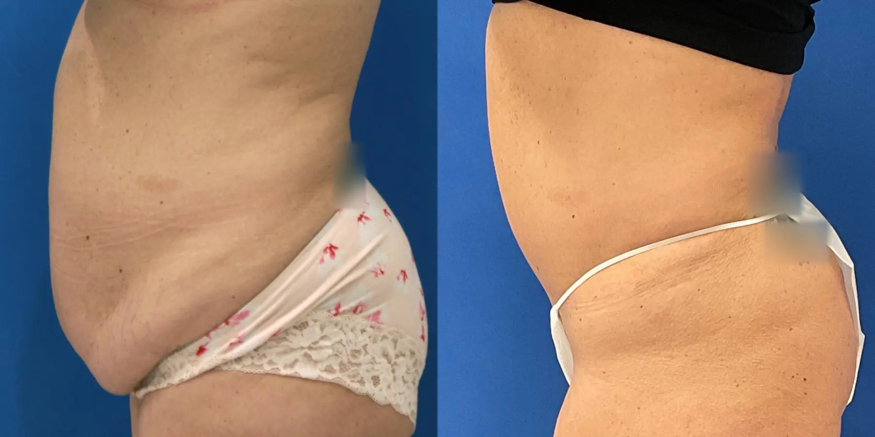 Tummy Tuck: Patient 35 - Before and After 2