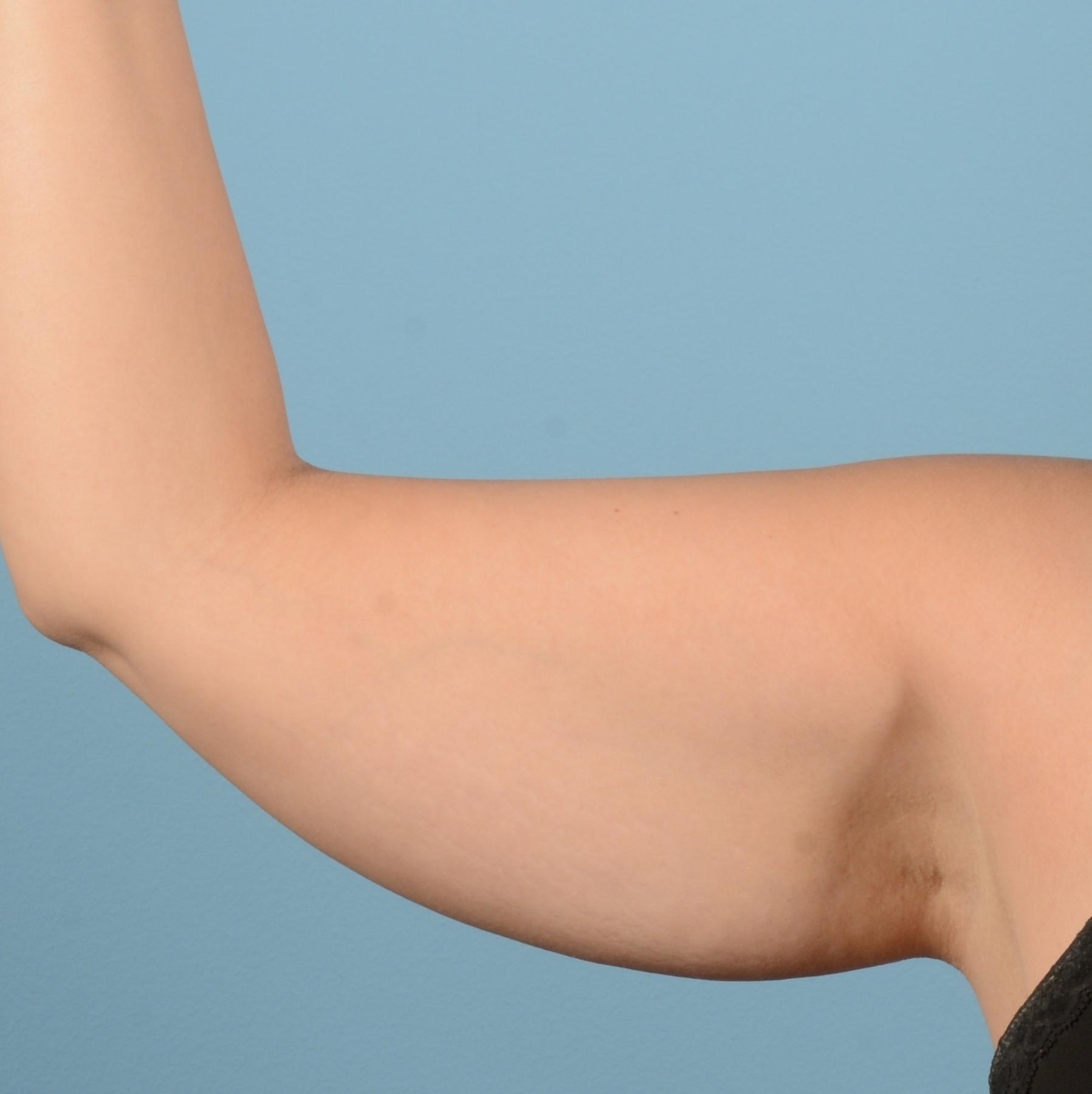 Liposuction: Patient 10 - Before 9