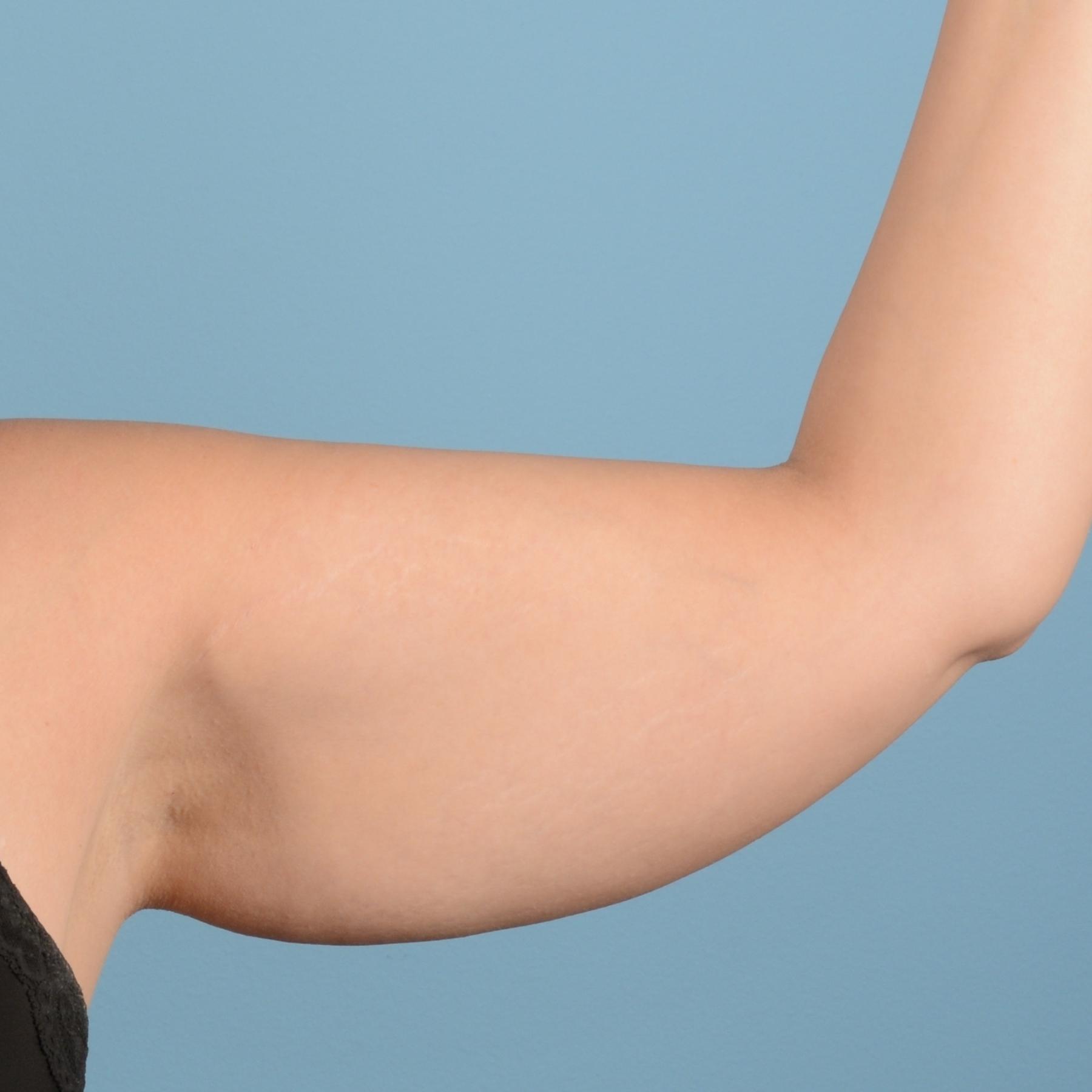 BodyTite: Patient 7 - Before and After 10