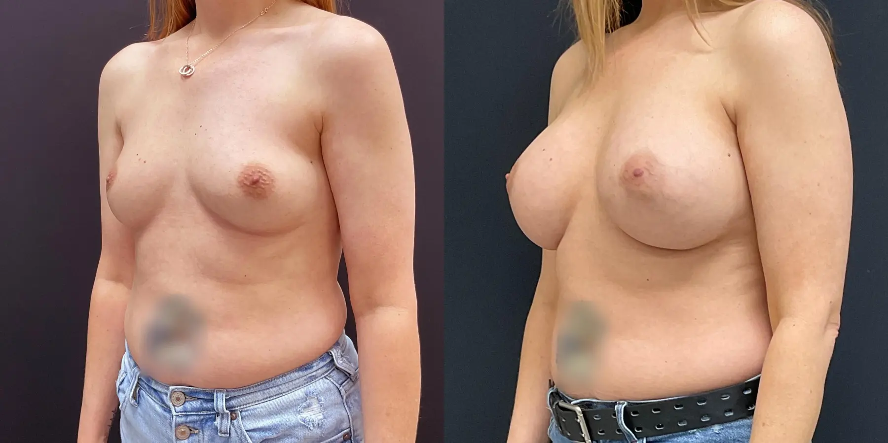Breast Augmentation: Patient 16 - Before and After 2