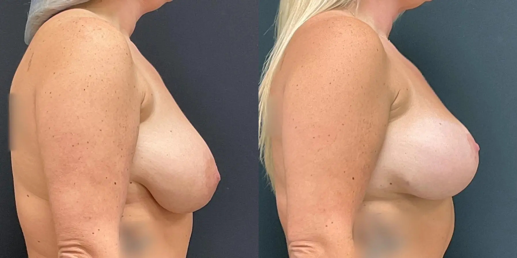 Breast Augmentation: Patient 24 - Before and After 5