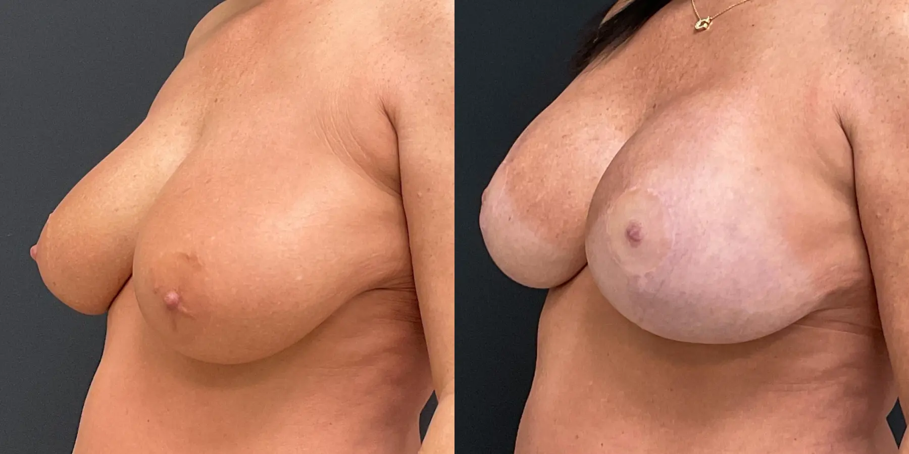 Breast Augmentation: Patient 19 - Before and After 2
