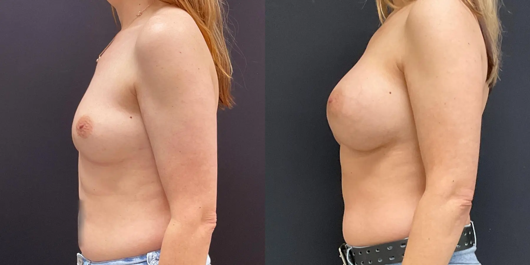 Breast Augmentation: Patient 16 - Before and After 4