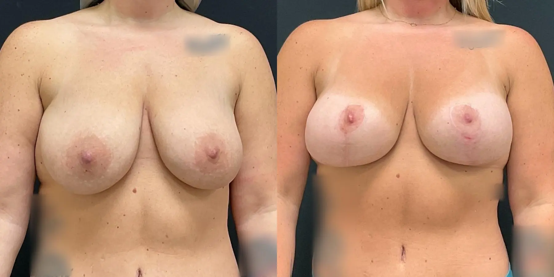 Breast Augmentation: Patient 11 - Before and After  