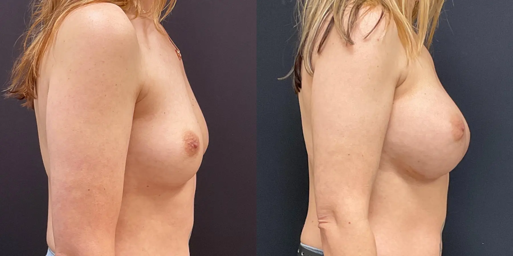 Breast Augmentation: Patient 16 - Before and After 5