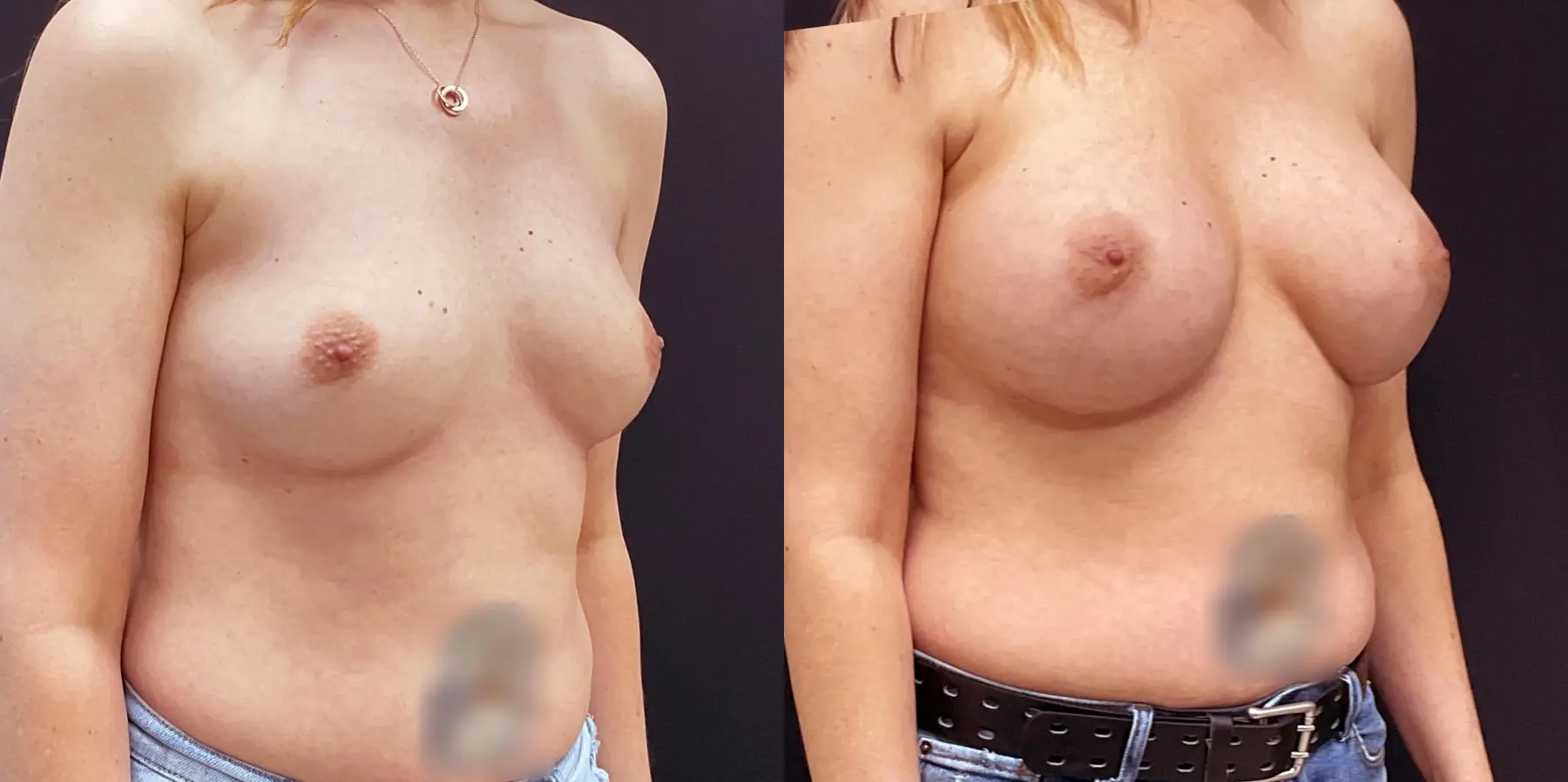 Breast Augmentation: Patient 16 - Before and After 3