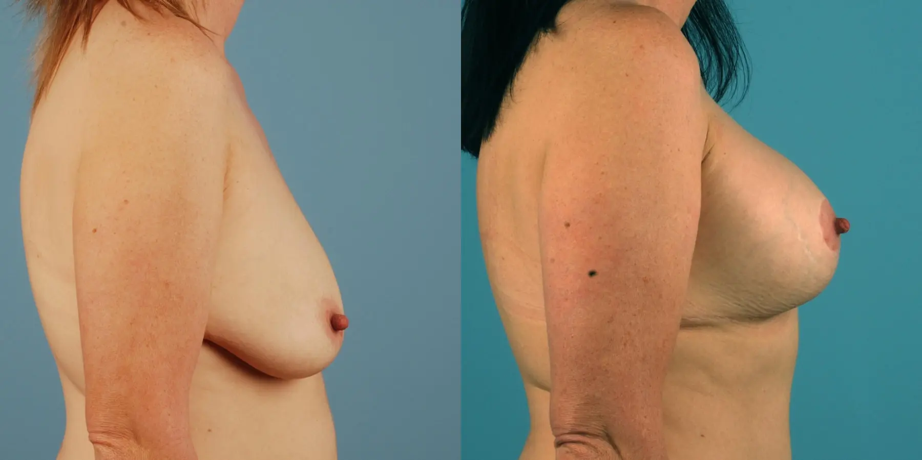 Breast Augmentation: Patient 21 - Before and After 2