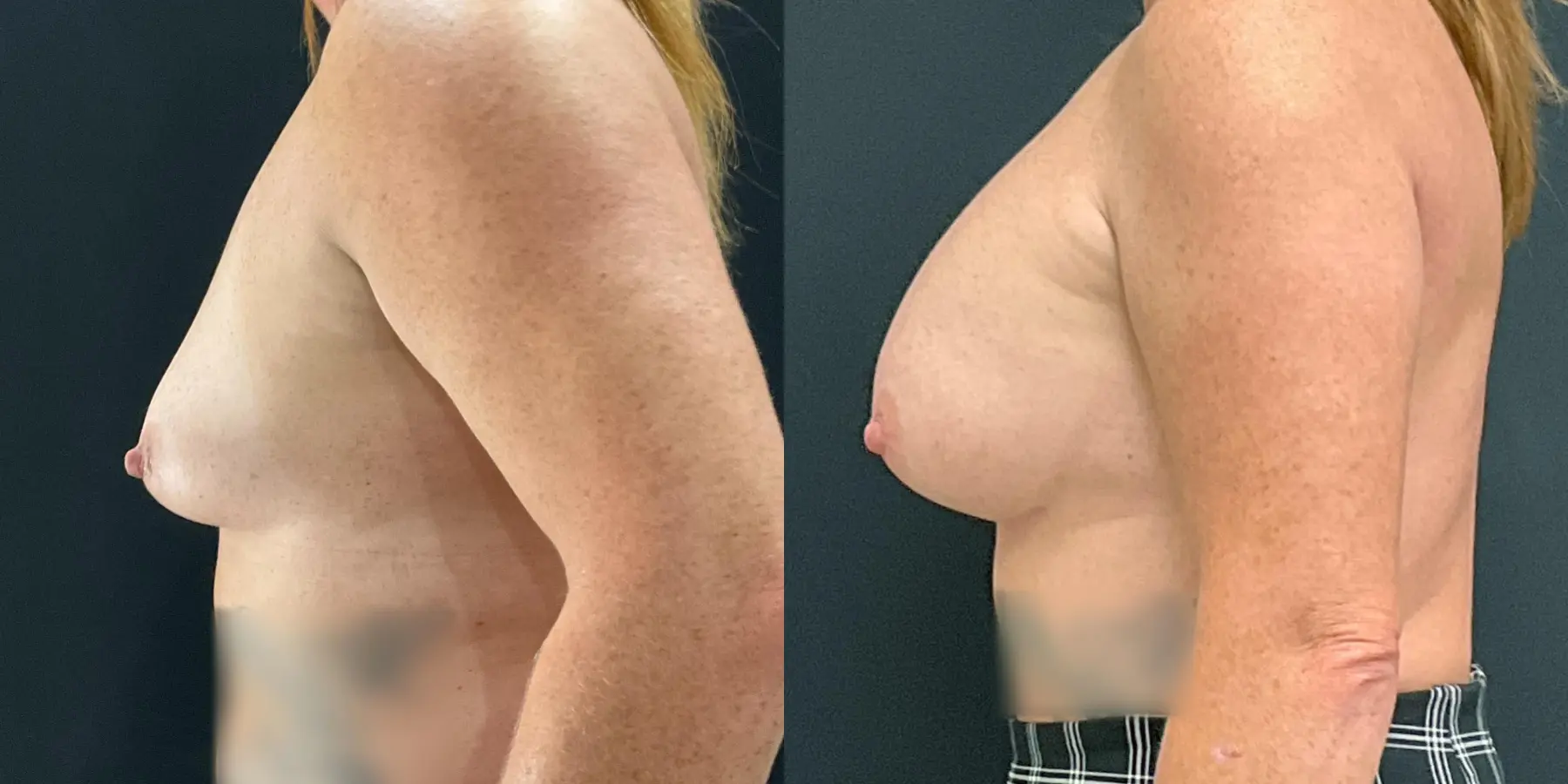 Breast Augmentation: Patient 4 - Before and After 4