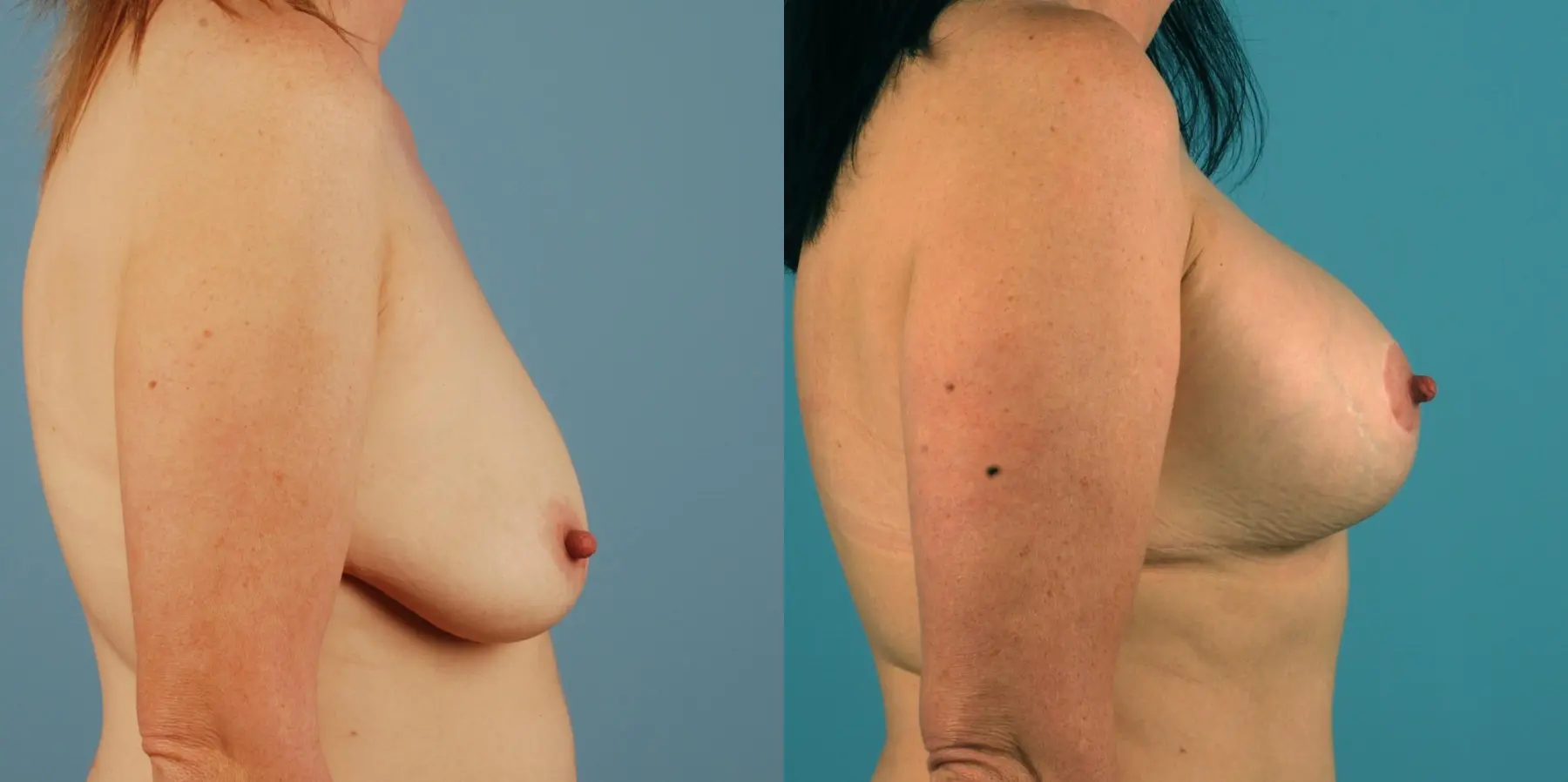 Breast Lift: Patient 11 - Before and After 2