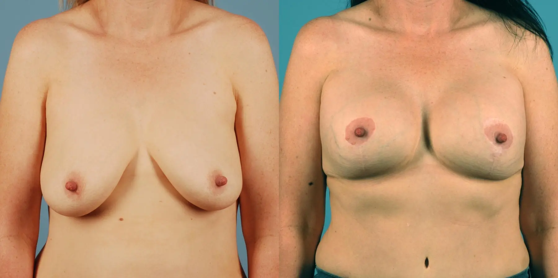 Breast Lift: Patient 11 - Before and After  