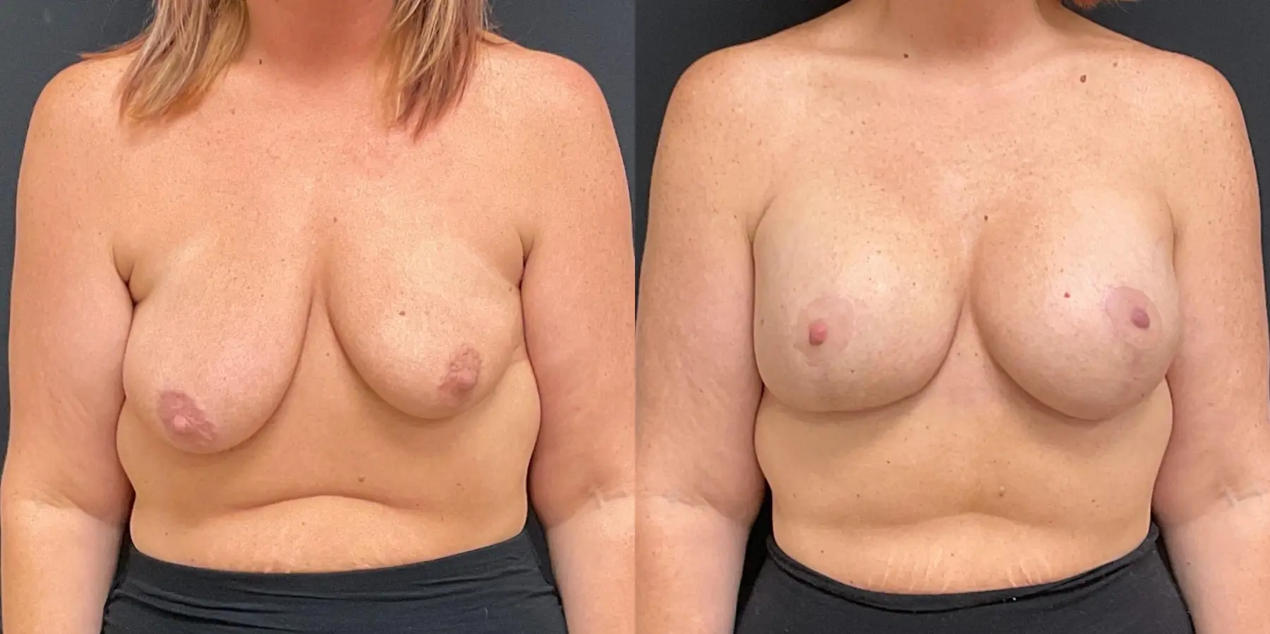 Breast Lift: Patient 13 - Before and After  