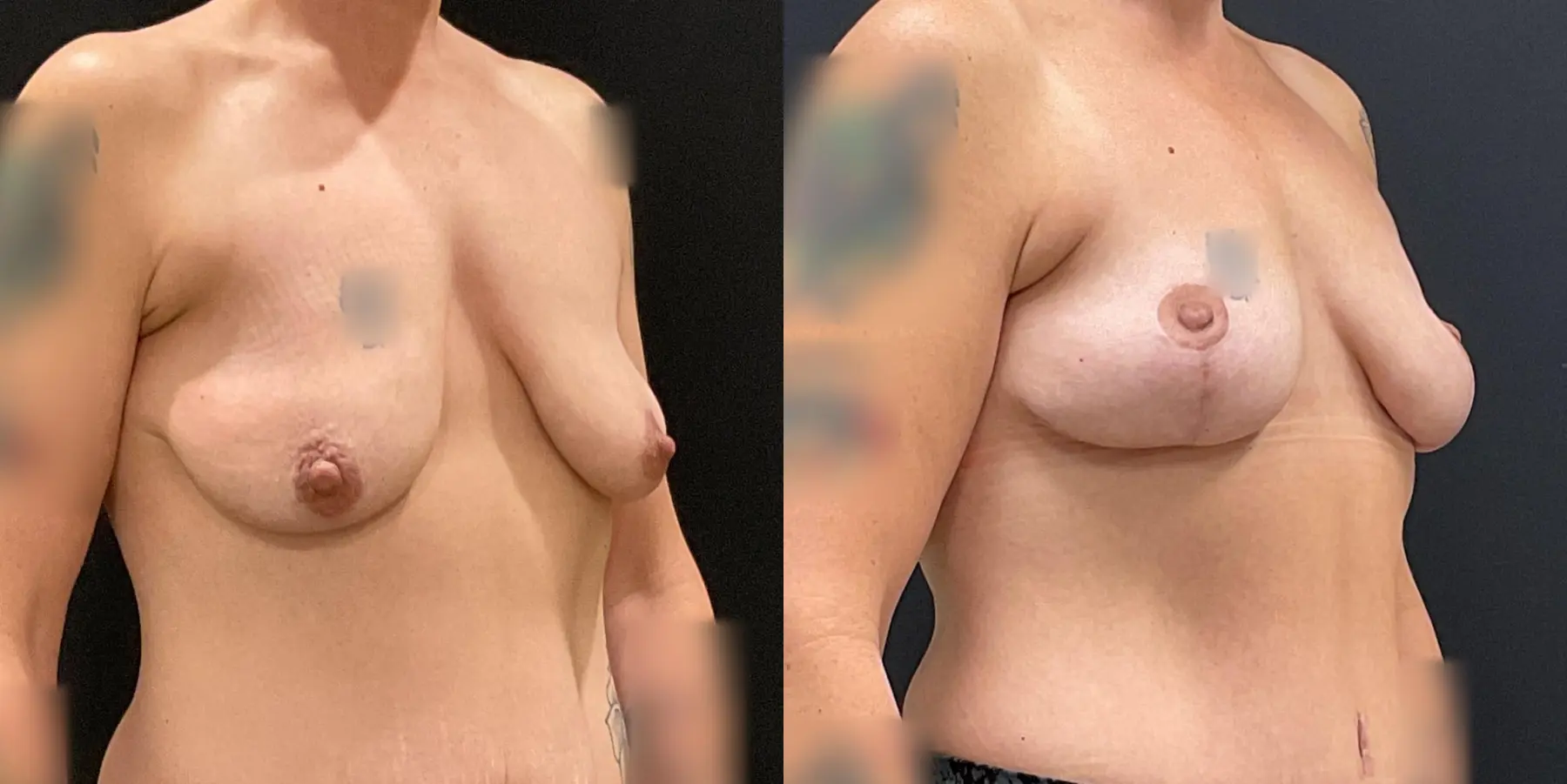 Breast Lift: Patient 2 - Before and After 3