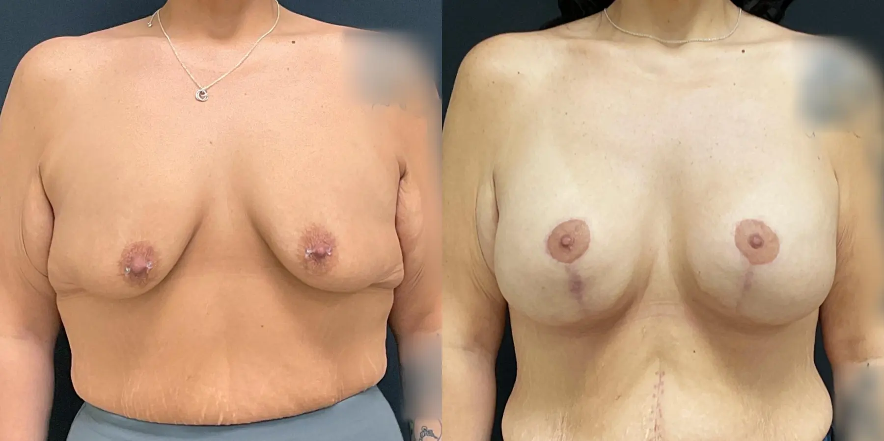 Breast Lift: Patient 14 - Before and After  