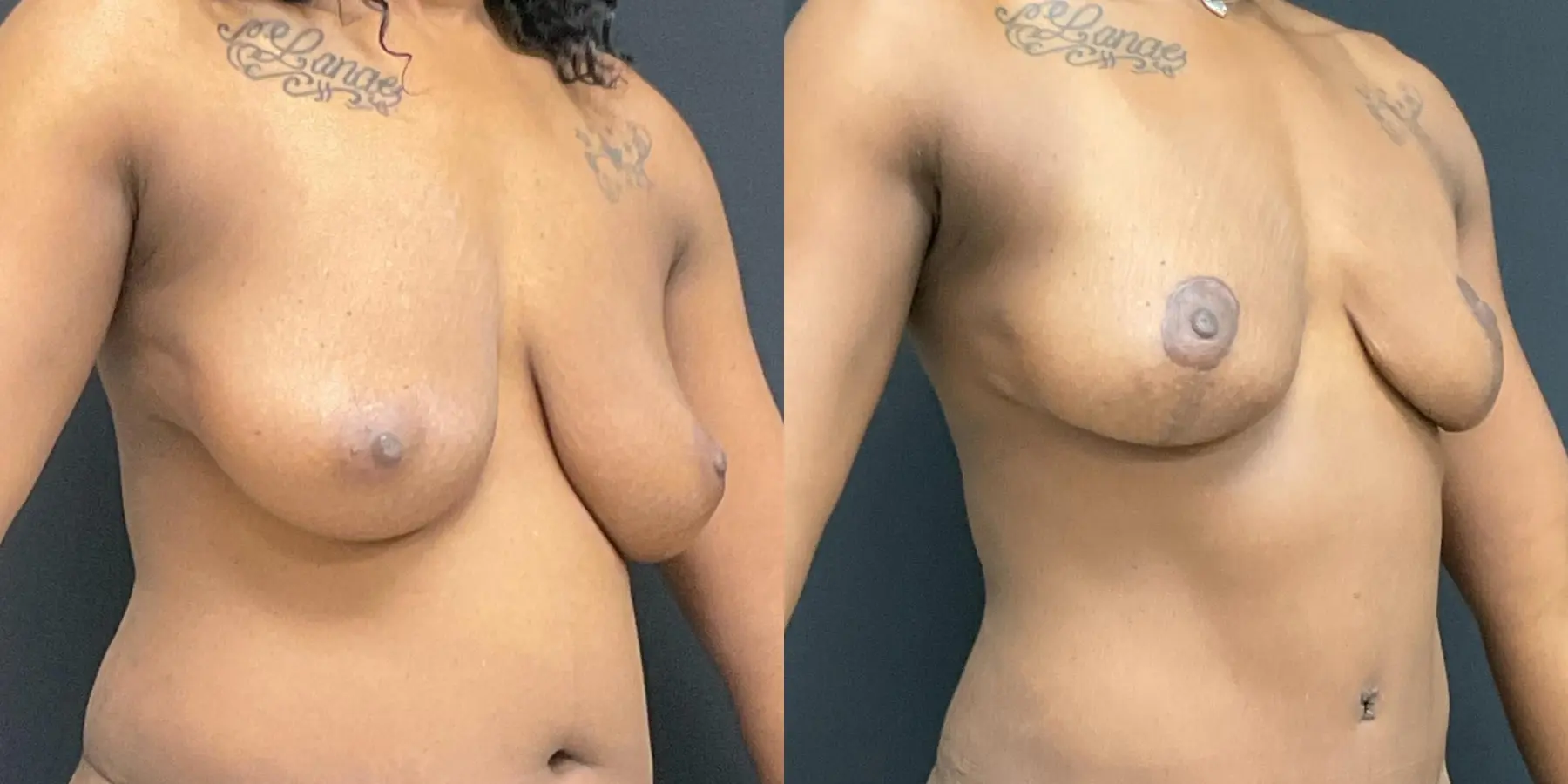 Breast Lift: Patient 4 - Before and After 3