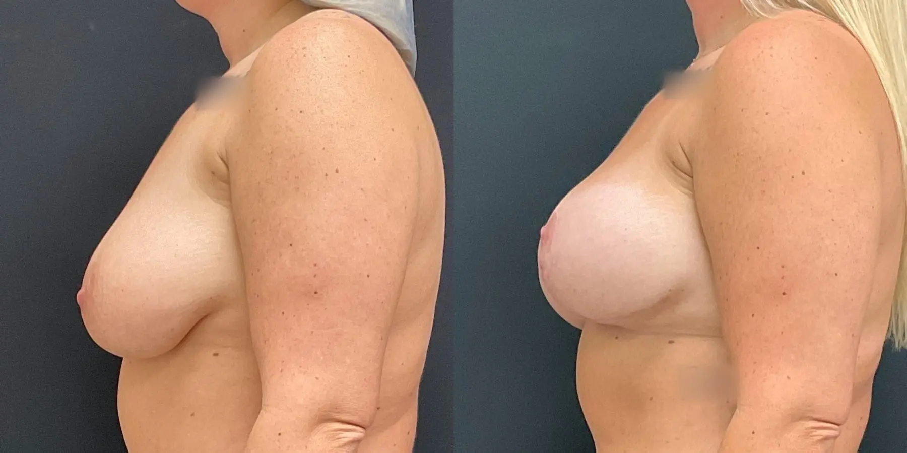 Breast Lift: Patient 9 - Before and After 4