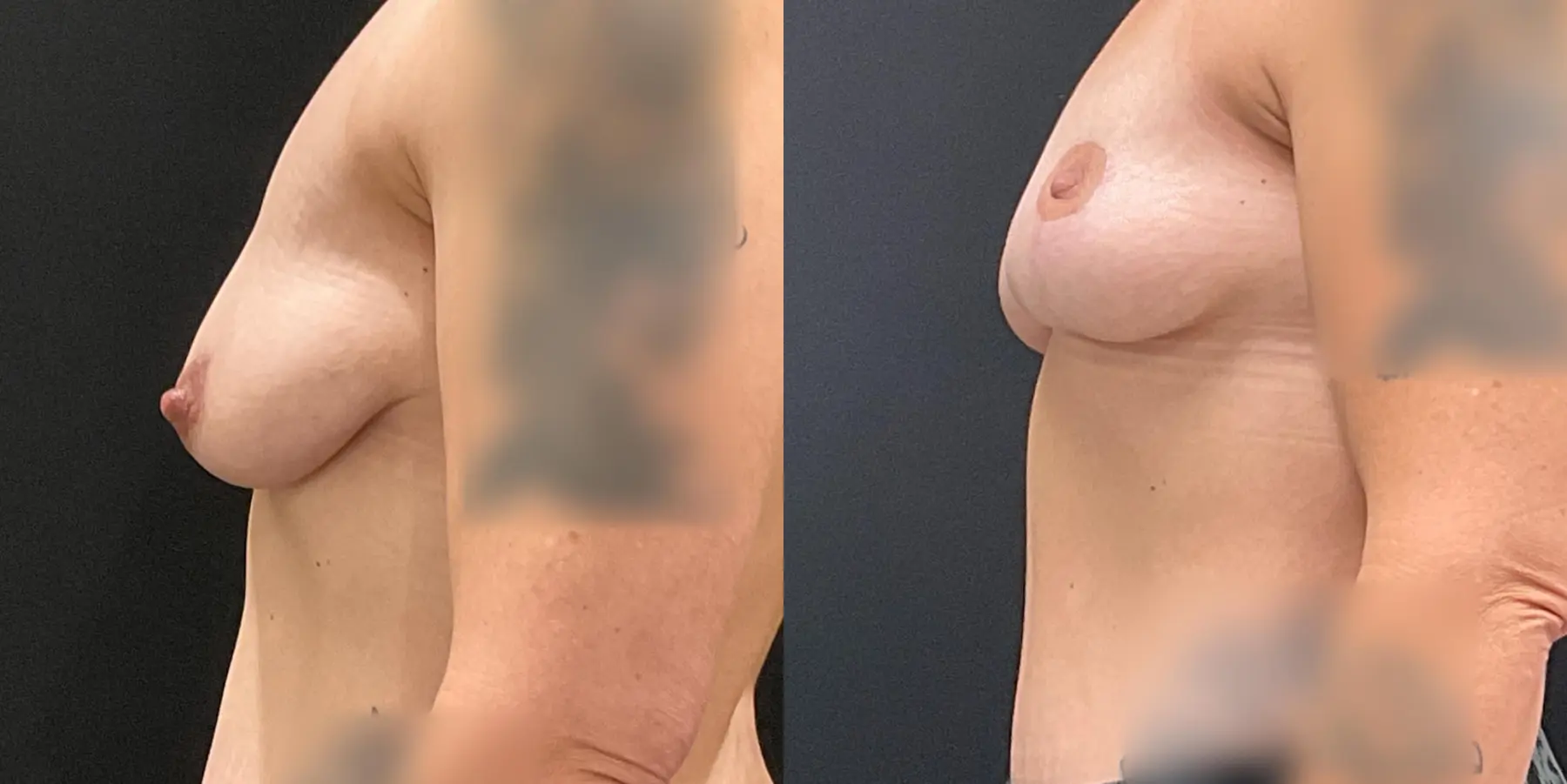 Breast Lift: Patient 2 - Before and After 4